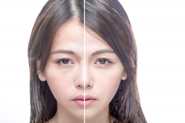痘痘肌怎么護(hù)膚，愛長(zhǎng)痘痘的皮膚怎么保養(yǎng)